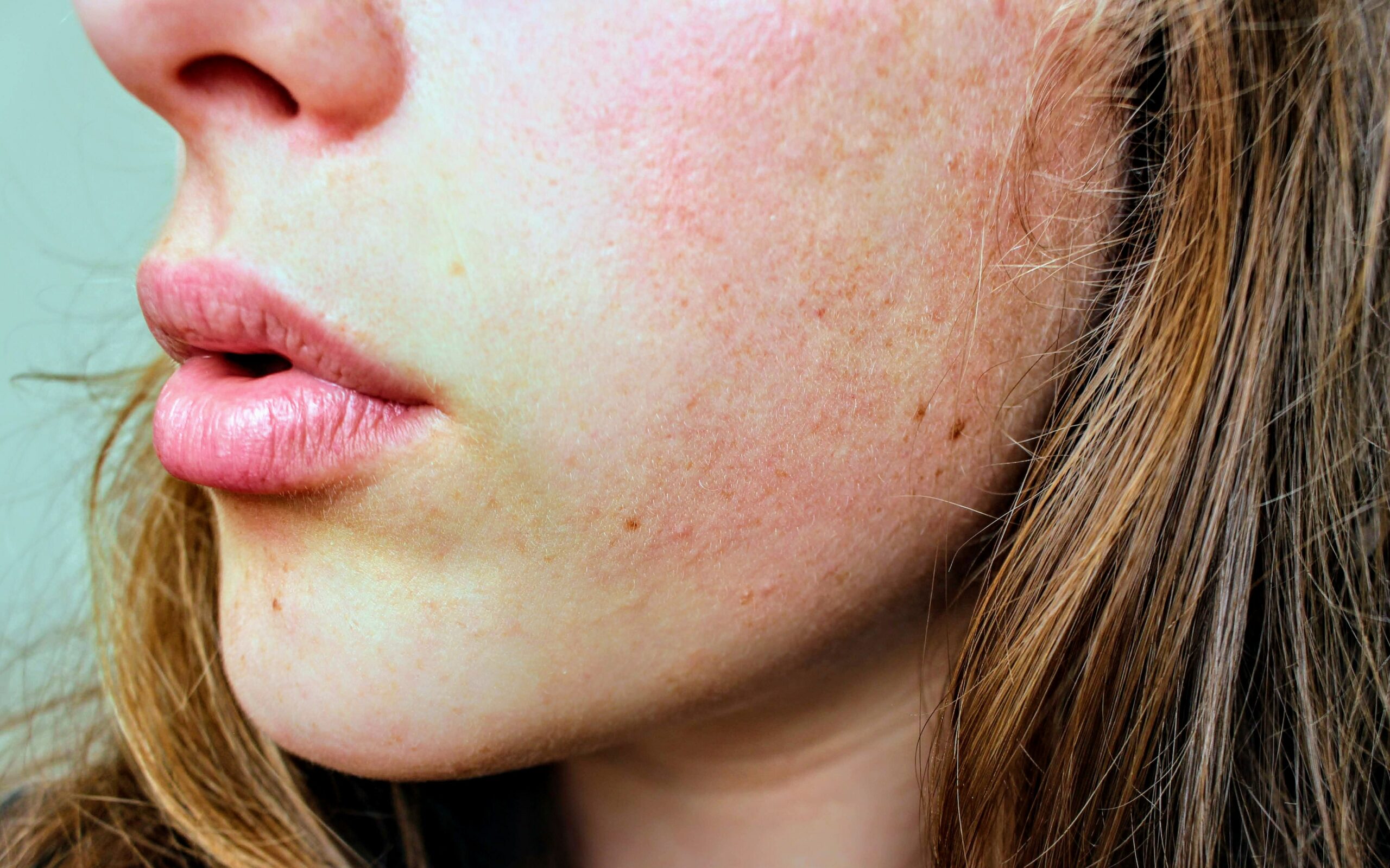 Flaky, peeling and irritated skin