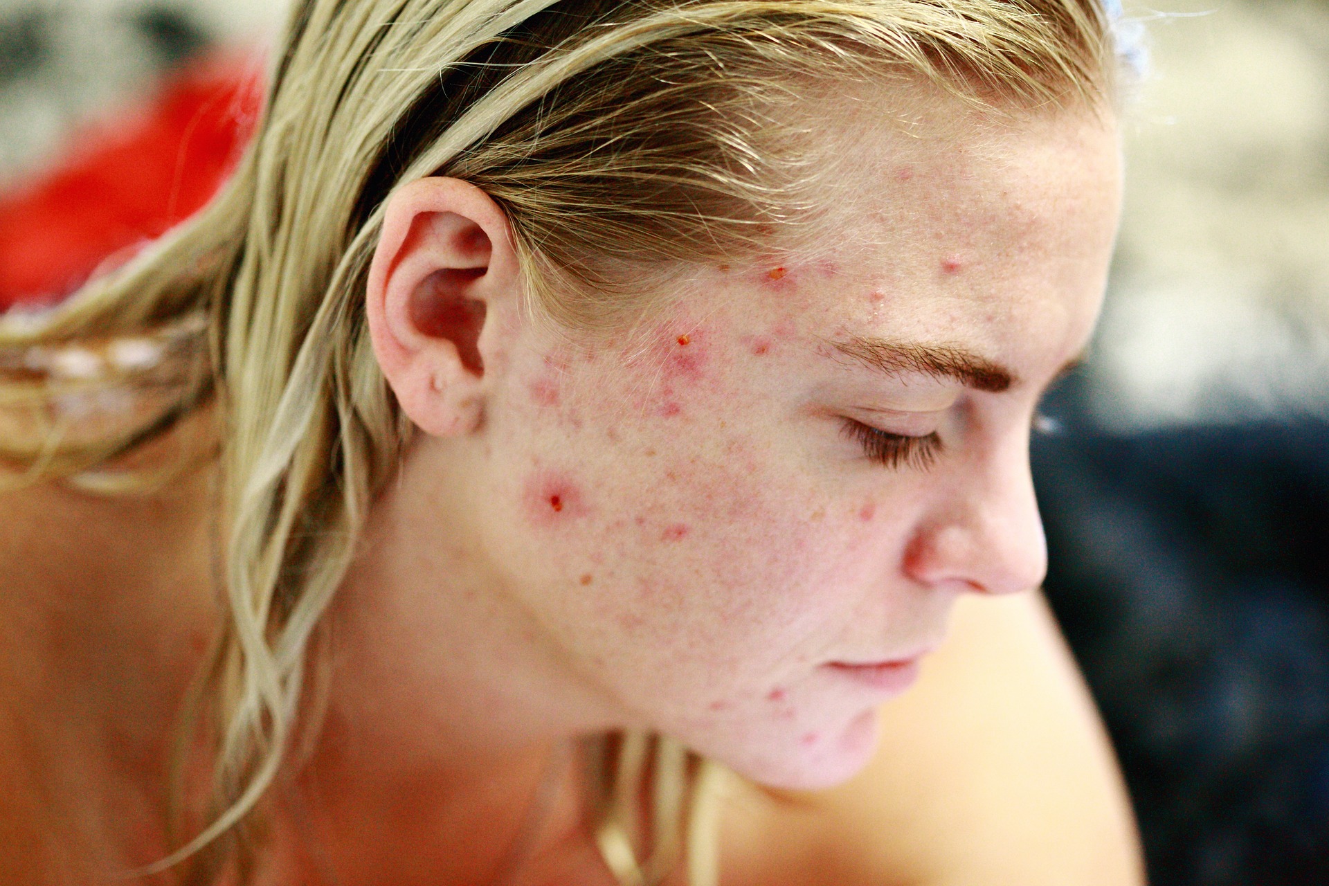Woman with acne lesions on the side of her face