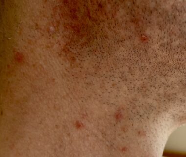 Ingrown hairs and razor burn on the neck after shaving