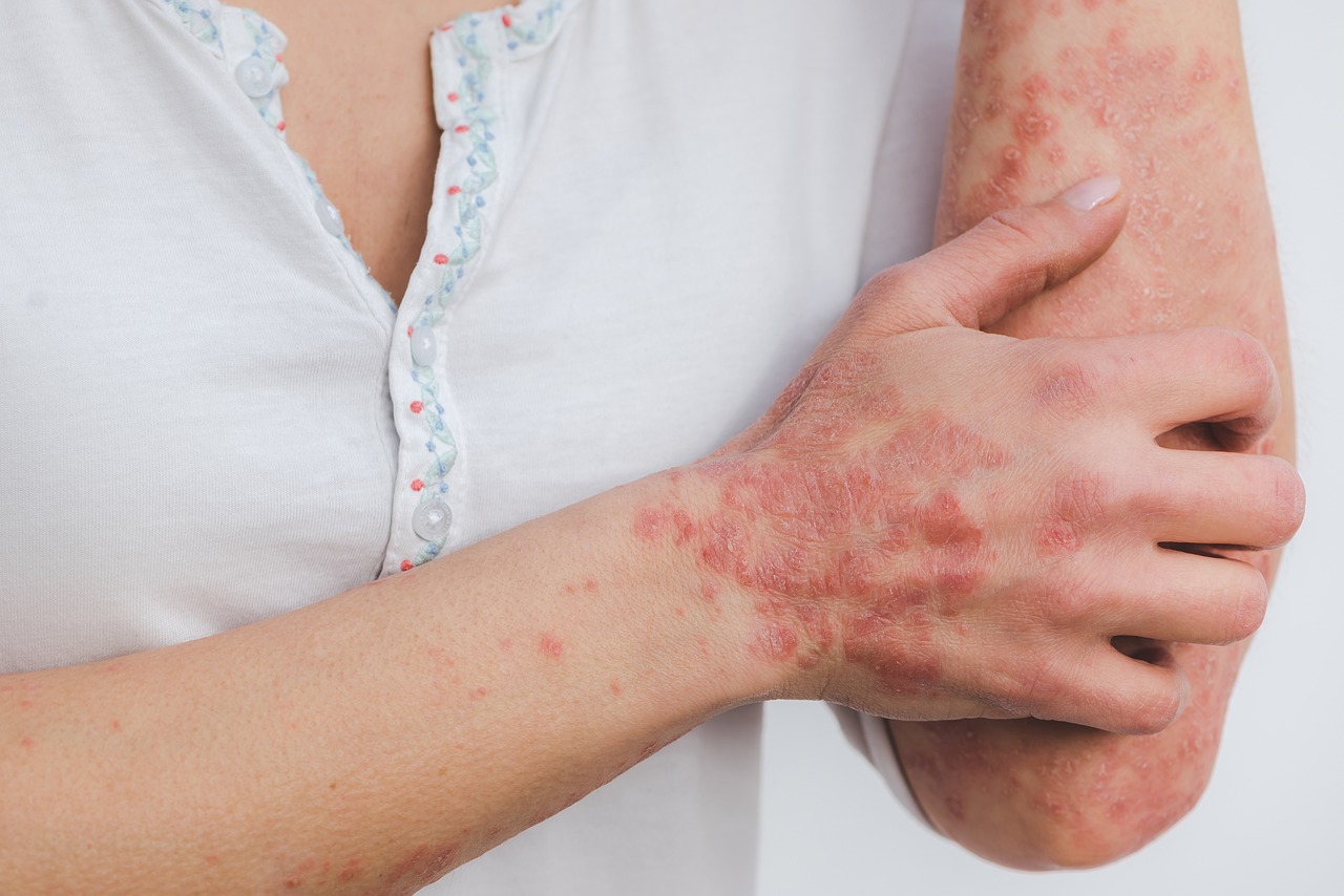 Inflamed skin conditions can lead to hyperpigmentation over time