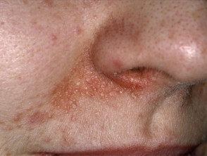 Periorificial dermatitis affecting the nose