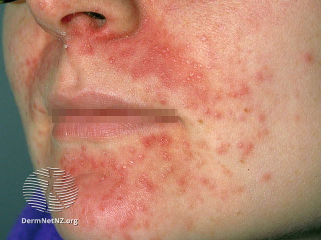 perioral dermatitis with halo around mouth