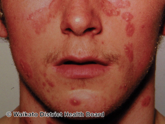 Psoriasis plaques on the face
