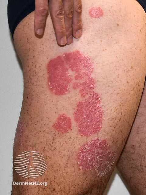 Plaque psoriasis