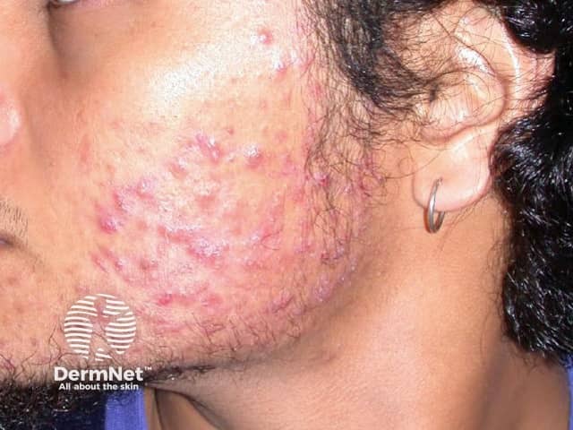 Cystic Acne on the cheek