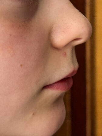 Blackheads on the nose