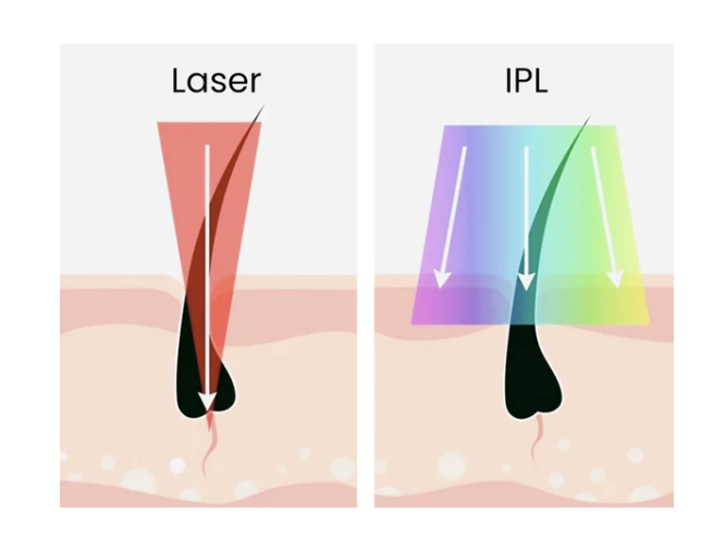 Difference between IPL and Laser